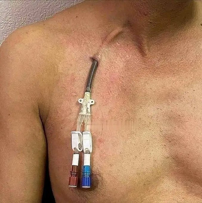 Nimerudi muuguzi wenu Mada ni kuhusu HEPATITIS, 
Je ni nini tofauti Kati ya HEPATOPULMONARY SYNDROME  and PORTO PULMONARY HYPERTENSION. 
haya sasa nimewaletea madkatari wa Twitter,  tupeni shule .
..Swali langu ni je ni ipi Ina contraindications na liver transplant?.