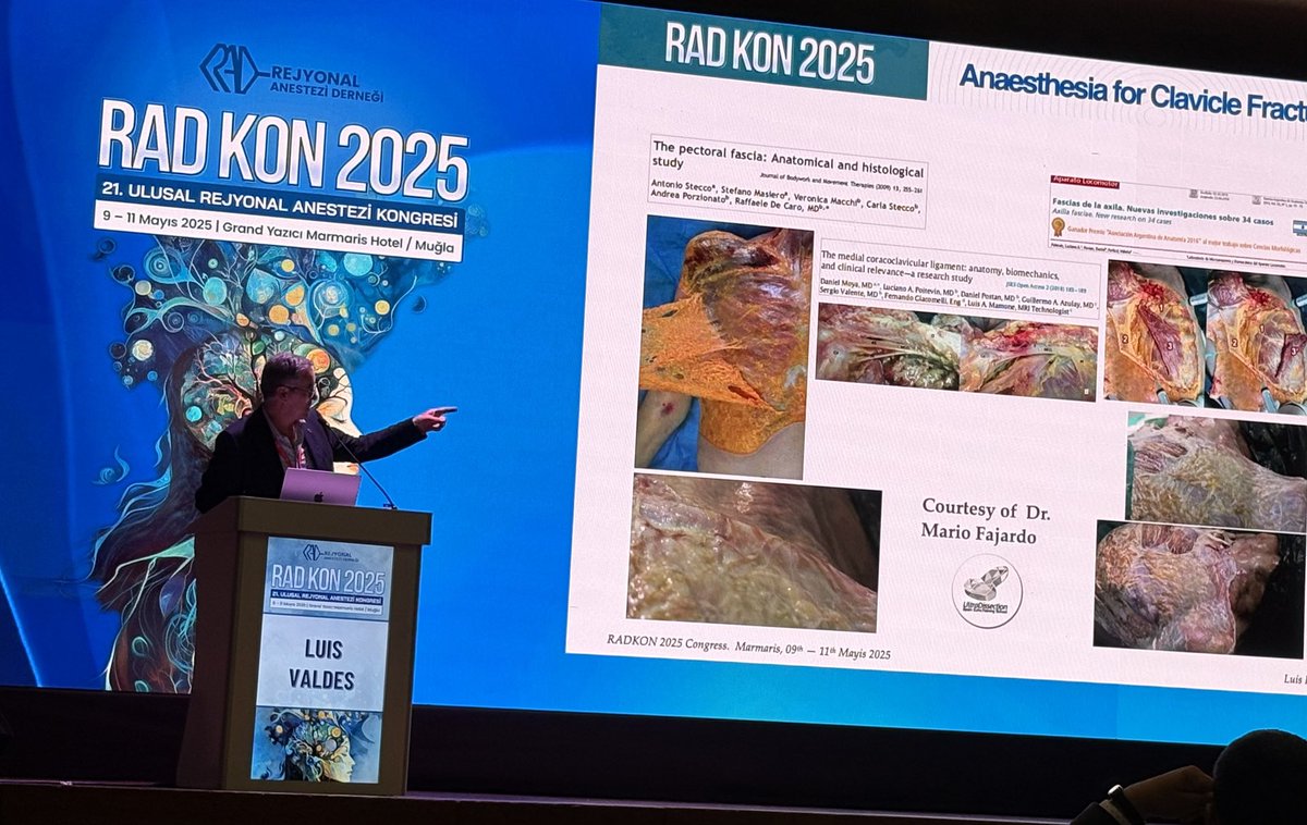 Prof.Dr. Alper Kılıçaslan (@k_alp_md) on Twitter photo At the Turkish Regional Anesthesia Congress, #RADKON2025, Dr.Luis Valdes delivered a fantastic presentation on ‘Regional Anesthesia for Clavicle Surgeries’ – packed with detailed anatomy and brilliant clinical insights! <a href="/TRegionalAnesth/">Rejyonal Anestezi Derneği</a> At the Turkish Regional Anesthesia Congress, #RADKON2025, Dr.Luis Valdes delivered a fantastic presentation on ‘Regional Anesthesia for Clavicle Surgeries’ – packed with detailed anatomy and brilliant clinical insights! <a href="/TRegionalAnesth/">Rejyonal Anestezi Derneği</a>