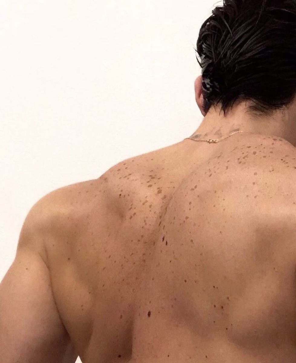 5/10 freckles of the day