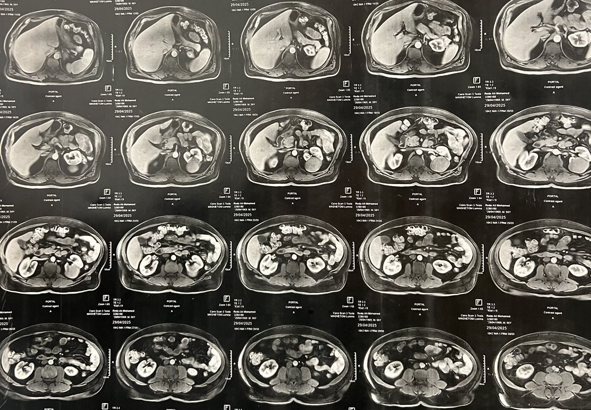 One of the most difficult cases that you may encounter is LPN of mid zonal cystic renal mass that reaches the renal sinus……..specially when the patient is a physician!