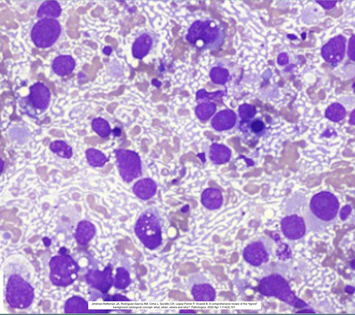 Path4People's tweet image. 🐅 Tigroid Background

💉 Seen in FNA, Diff-Quik stains 

🔬 In Tumors w ⬆️ Glycogen; Cytoplasmic Fragility; +/- Clear Cell morphology

Examples: Seminoma, Ewing&apos;s, Parathyroid adenoma, Clear cell Sarcoma, Squamous cell carcinoma (clear cell variant).

#pathx #cytopath #pathology