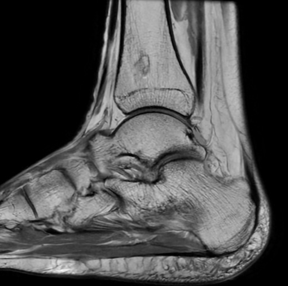 Diana Guzmán Vásquez (@hasbleidy28) on Twitter photo ¿Qué son los infartos óseos?  
Lo más frecuente es que sean osteonecrosis asépticas que afectan huesos largos. 
Suelen ser benignos y asintomáticos, diagnosticándose accidentalmente en pruebas  que se solicitan con otro motivo.
No olvidar en  caso de duda gammagrafía. ¿Qué son los infartos óseos?  
Lo más frecuente es que sean osteonecrosis asépticas que afectan huesos largos. 
Suelen ser benignos y asintomáticos, diagnosticándose accidentalmente en pruebas  que se solicitan con otro motivo.
No olvidar en  caso de duda gammagrafía.