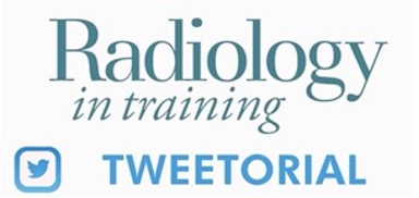 1/
🧠 Ever wondered why removing only the enhancing part of #glioblastoma isn’t always enough? 🤔 Moon et al. explored why extending resection to noncontrast-enhancing tumor (NET) matters—a lot! 🤯 Let’s explore this further in this #Tweetorial !👇
#RadInTraining #NeuroTwitter
