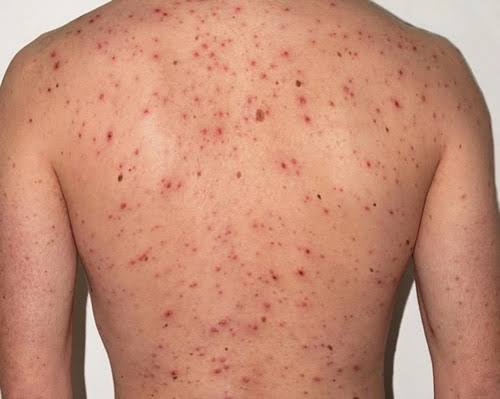 🚨El <a href="/Minsa_Peru/">Ministerio de Salud</a> ha emitido una alerta epidemiológica a todos los servicios de salud tras confirmar un caso importado de #sarampión en un niño de 11 años que viajó a Estados Unidos, donde uno de sus familiares fue diagnosticado con esta enfermedad.🧵