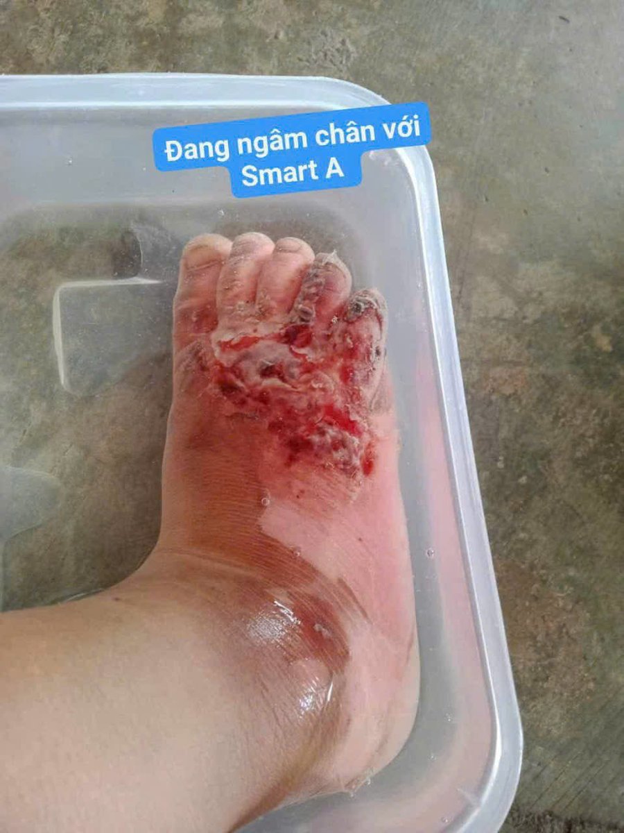DucTuan_'s tweet photo. Con của Dược Sĩ bệnh viện đa khoa Đà nẵng bị bỏng. Dược sĩ thấy nếu chữa theo cách thông thường sẽ đau đớn, lâu khỏi và có nguy cơ sẹo nên tin Smart A. Kết quả ko bao giờ phụ lòng bất kỳ ai❤💝 https://t.co/xBnn9AP2n2