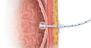 Our case of the month is about removing a PEG tube

Highlights lots of learning points including communication, delegating without checking experience &amp; other factors

No harm came to the patient as the trainee recognised his limitations &amp; called for help

coress.org.uk/case-of-the-mo…