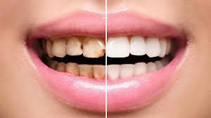 The Ultimate Solution for Dental Plaque

Brushing twice daily alone won’t cut it in the battle against tartar. This stubborn buildup on your teeth is essentially bacteria encased in a mineralized fortress.

Here’s a straightforward remedy with 3 ingredients to tackle tartar..