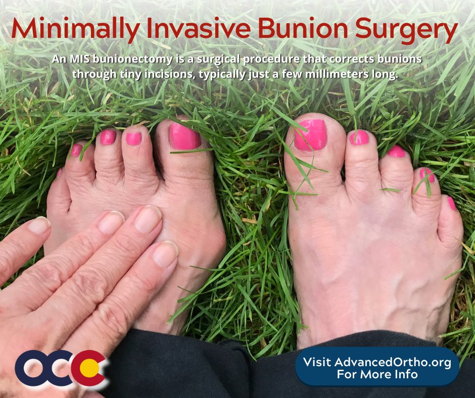 Minimally invasive bunion surgery is now offered by Dr. Alan Ng. Learn the differences from traditional bunion surgery zurl.co/uMpcr