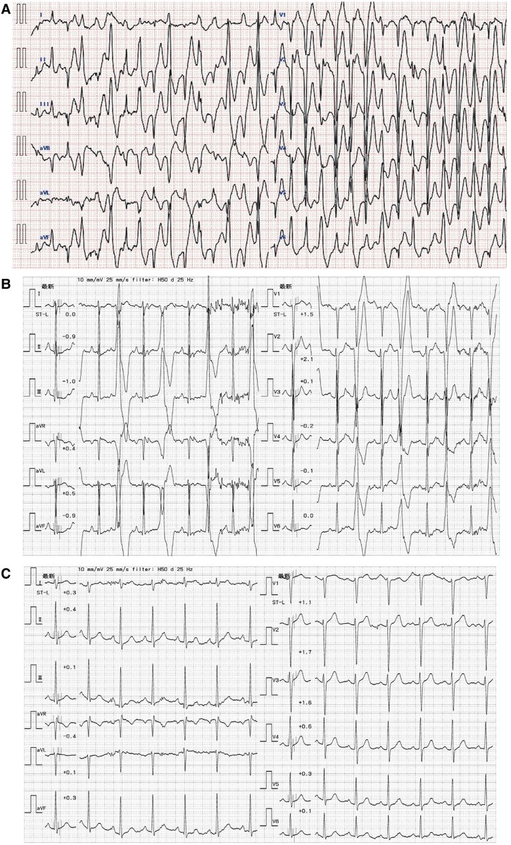 European Society of Cardiology Journals (@esc_journals) on Twitter photo 15/M presents with cardiac arrest requiring CPR; his mother also had a history of cardiac arrest. What is the likely dx? ow.ly/goVF50VOP5w
#EHJCaseReports <a href="/Phiso_de/">Philipp Sommer</a> <a href="/TJ_Yeo/">Tee Joo YEO</a> <a href="/aayshacader/">Aaysha Cader</a> <a href="/BoldiKovacsMD/">Boldizsar Kovacs</a> <a href="/KardiologieHH/">Erik Rafflenbeul</a> <a href="/ANazmiCalik/">A.Nazmi Calik</a> <a href="/O_Azizy_MD/">Obayda Azizy</a> <a href="/saramoscatelli7/">Sara Moscatelli</a> <a href="/EHJCREiC/">EHJCaseReports Editor-in-Chief</a> 15/M presents with cardiac arrest requiring CPR; his mother also had a history of cardiac arrest. What is the likely dx? ow.ly/goVF50VOP5w
#EHJCaseReports <a href="/Phiso_de/">Philipp Sommer</a> <a href="/TJ_Yeo/">Tee Joo YEO</a> <a href="/aayshacader/">Aaysha Cader</a> <a href="/BoldiKovacsMD/">Boldizsar Kovacs</a> <a href="/KardiologieHH/">Erik Rafflenbeul</a> <a href="/ANazmiCalik/">A.Nazmi Calik</a> <a href="/O_Azizy_MD/">Obayda Azizy</a> <a href="/saramoscatelli7/">Sara Moscatelli</a> <a href="/EHJCREiC/">EHJCaseReports Editor-in-Chief</a>