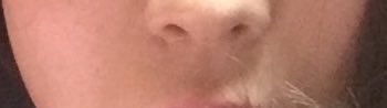 sariabeaucool's tweet photo. 左は私の人中短縮前の鼻。やっぱり鼻腔に丸みがあった👃🥹

それが内側人中後は右のように鼻の穴に丸みが無くなって、下伸び、外向きの鼻の穴になる。これ人中短縮興味ある人に顔見られたら一発でバレるレベル😂 https://t.co/UlgRKknrls