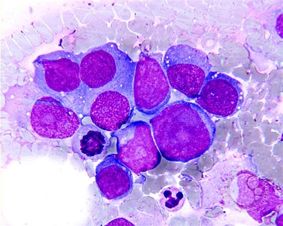 plasmablastic lymphoma | ASH Image Bank | American Society of Hematology imagebank.hematology.org/image/6377/pla… #ASHImageBank #lymsm