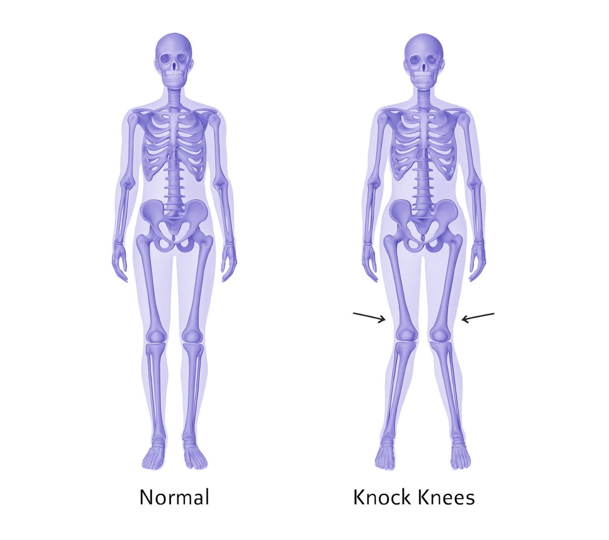 thebendapp's tweet image. Millions of people have “knock knees,” often undiagnosed.

Even mild cases can:
• cause knee &amp;amp; hip pain
• make you walk with a “waddle”

The good news? Many cases are correctable without surgery.

A thread on knock knees and how to realign them 🧵: