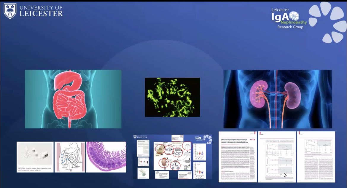 Wonderful IgAN seminar by <a href="/SaynaNorouzi/">Sayna Norouzi, MD, FASN</a> and <a href="/IgAN_JBarratt/">Jonathan Barratt</a> <a href="/GlomCon/">GlomCon</a> 💫