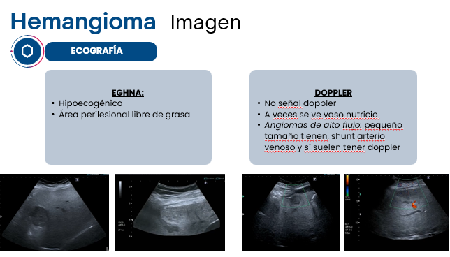 Poco queda para el final de nuestra residente Dra. R. Díaz👐😆
Termina su ciclo de sesiones clínicas conversando sobre las Guías de lesiones focales hepáticas de <a href="/AmCollegeGastro/">ACG</a> y la <a href="/EASLedu/">EASL Education</a> 
Hoy el hemangioma....