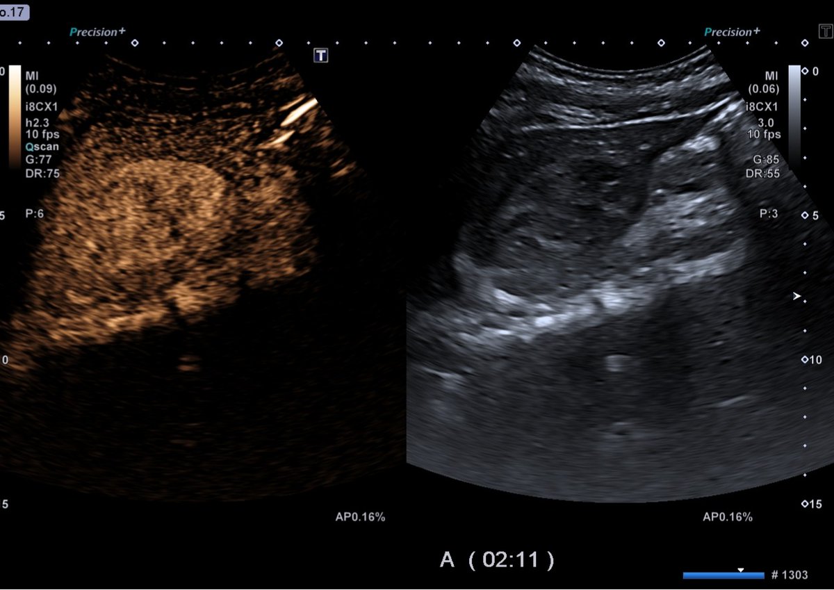 #fansecografiadigestivo
FASE ARTERIAL: Realce periférico nodular
FASE PORTAL: Relleno centrípeto, progresivo, parcial o completo
FASE TARDÍA: Realce tardío, áreas no realzadas (trombosis/fibrosis)
🏥👉HEMANGIOMA