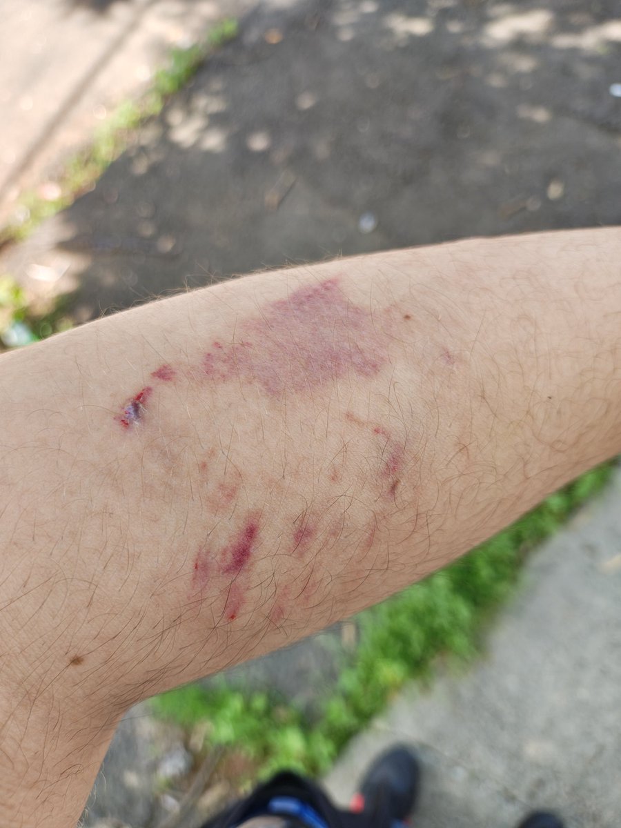 I just got bit by a big dog as I was walking toward the corner store for a walk. Even the owner laughed and didn't seem to care. 😭