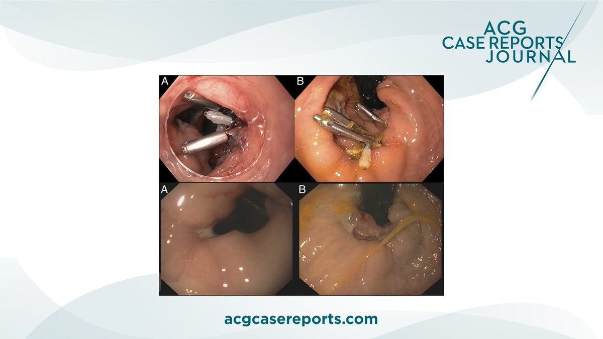 ACGCRJ (@acgcrj) on Twitter photo 🔎 Video: Successful Closure of a Large Rectal Perforation Secondary to an Unusual Foreign Body Using Endoscopic Clip and Loop Technique (King Closure)
Dhar, et al.
👉 bit.ly/4m7cYdH
<a href="/PrateekHarne1/">Prateek Harne MBBS, MD</a> <a href="/NadeemYousafMD/">Nadeem Yousaf</a> <a href="/DharJahnvi/">Jahnvi Dhar</a> <a href="/DeshidiSrinu/">Srinu Deshidi</a> <a href="/Samanta_JayPGI/">Samanta Jayanta</a> 🔎 Video: Successful Closure of a Large Rectal Perforation Secondary to an Unusual Foreign Body Using Endoscopic Clip and Loop Technique (King Closure)
Dhar, et al.
👉 bit.ly/4m7cYdH
<a href="/PrateekHarne1/">Prateek Harne MBBS, MD</a> <a href="/NadeemYousafMD/">Nadeem Yousaf</a> <a href="/DharJahnvi/">Jahnvi Dhar</a> <a href="/DeshidiSrinu/">Srinu Deshidi</a> <a href="/Samanta_JayPGI/">Samanta Jayanta</a>