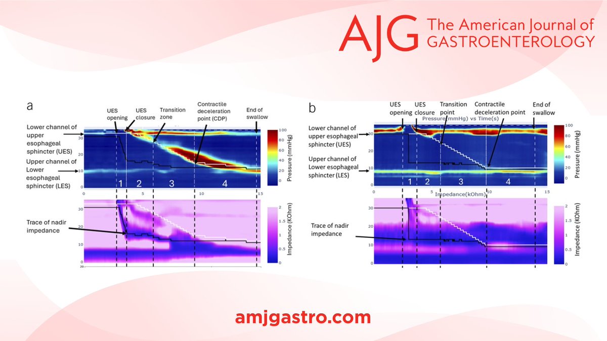 AJG - The American Journal of Gastroenterology (@amjgastro) on Twitter photo In the #RedJournal:
Four-Dimensional Impedance Manometry in Esophageal Motility Disorders
Goudie, et al.
📕 bit.ly/4jTcshQ
<a href="/JPandolfinoMD/">John E. Pandolfino</a> <a href="/ikaraujoa/">Isis Araujo</a> <a href="/souravhalder92/">Sourav Halder</a> <a href="/MLongMD/">Millie Long</a> <a href="/JasmohanBajaj/">Jasmohan Bajaj</a> In the #RedJournal:
Four-Dimensional Impedance Manometry in Esophageal Motility Disorders
Goudie, et al.
📕 bit.ly/4jTcshQ
<a href="/JPandolfinoMD/">John E. Pandolfino</a> <a href="/ikaraujoa/">Isis Araujo</a> <a href="/souravhalder92/">Sourav Halder</a> <a href="/MLongMD/">Millie Long</a> <a href="/JasmohanBajaj/">Jasmohan Bajaj</a>