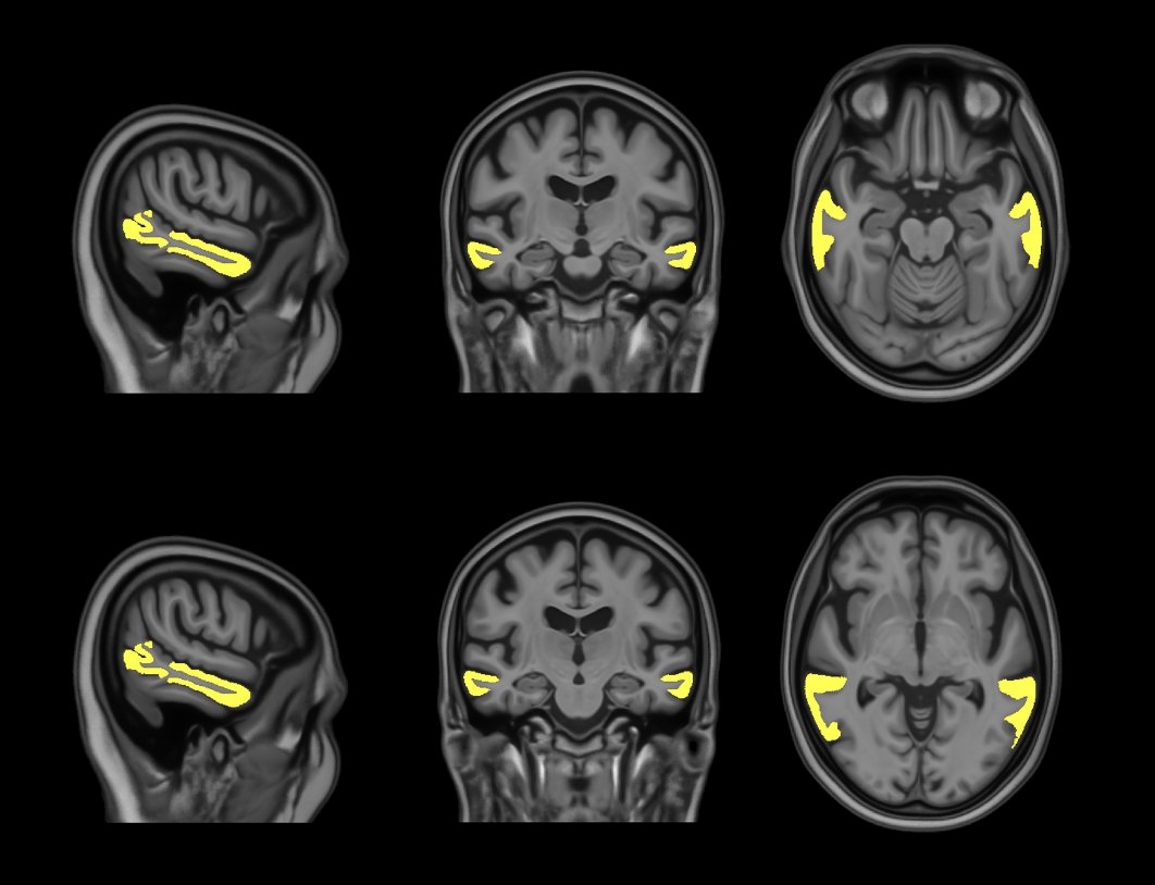 Ana Tomash will present her most recent findings on the link between brain arteriolosclerosis pathology and in-vivo cortical volumes in community-based older adults 
📆Wed, May 14
🕐14:30 HST
📍Poster #3775, Computer #119
#ISMRM2025 
Session: Aging – Structure &amp; Microstructure