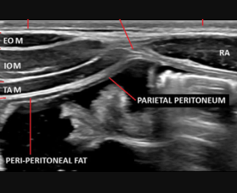 ASA (@asasonography) on Twitter photo đ Pseudohernia is an important differential to incisional hernia. This Sonography article with a CPD test discusses the relevant anatomy and sonographic technique to guide sonographers when considering pseudohernia as a diagnosis. <a href="/WileyHealth/">Wiley Clinical Health</a>
loom.ly/bIbU8No đ Pseudohernia is an important differential to incisional hernia. This Sonography article with a CPD test discusses the relevant anatomy and sonographic technique to guide sonographers when considering pseudohernia as a diagnosis. <a href="/WileyHealth/">Wiley Clinical Health</a>
loom.ly/bIbU8No