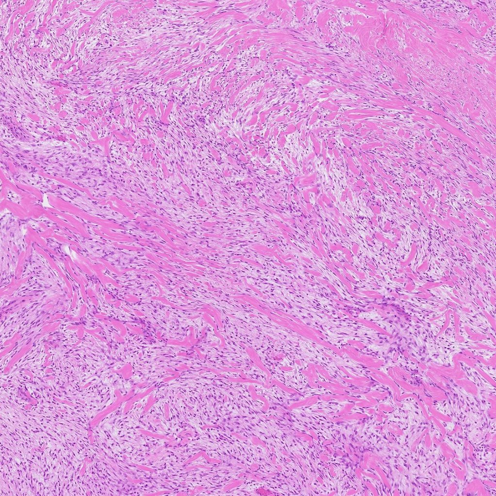 Rosenrot_Path's tweet photo. A rare case of fibromatosis-like metaplastic breast cancer. Tumor cells are predominantly spindle to stellate shape. Marked collagenous bundles resemble skeletal muscle at low magnification. If you are lucky, you may find mitosis or subtle epithelial differentiation.
#BreastPath https://t.co/2e3dHzjPUW