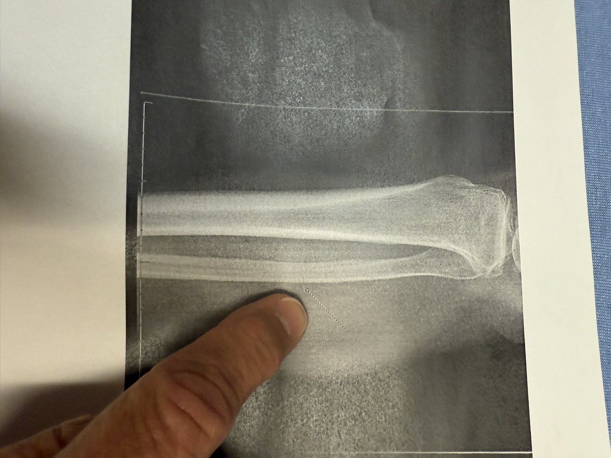 OKCbrickman's tweet image. Playoff pain for real! Crashed yesterday in CO mtb race and hobbled around until post game. Fracture in fibula #crutches #bummer #thunderup