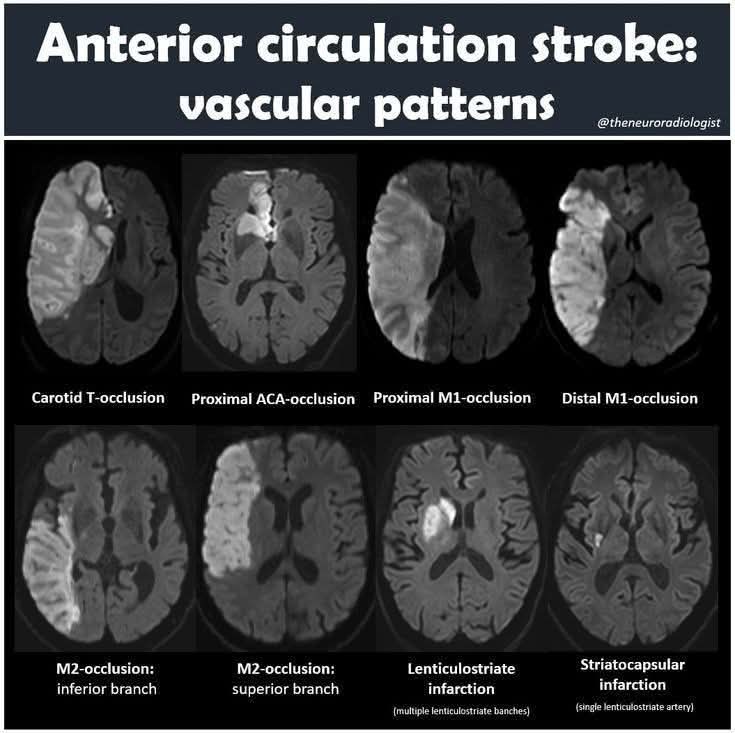 Anterior Circulation stroke - Vascular Patterns