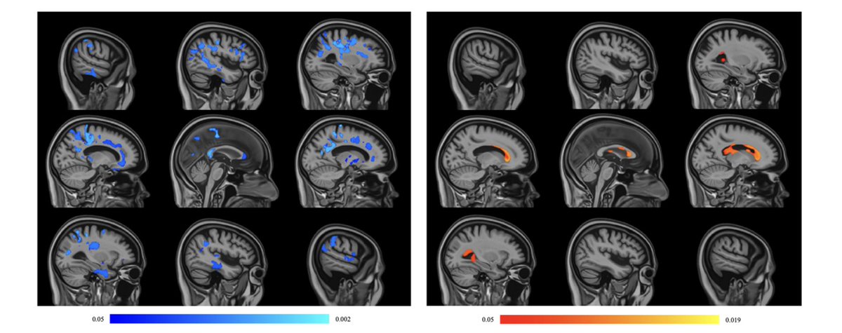 Khalid Saifullah will present evidence that plasma neurofilament light NfL is associated with less brain tissue and larger ventricles, but also with higher white matter hyperintensity volume.
📅 Monday, May 12
🕐 14:45–15:45 
Traditional poster 4856
#ISMRM2025