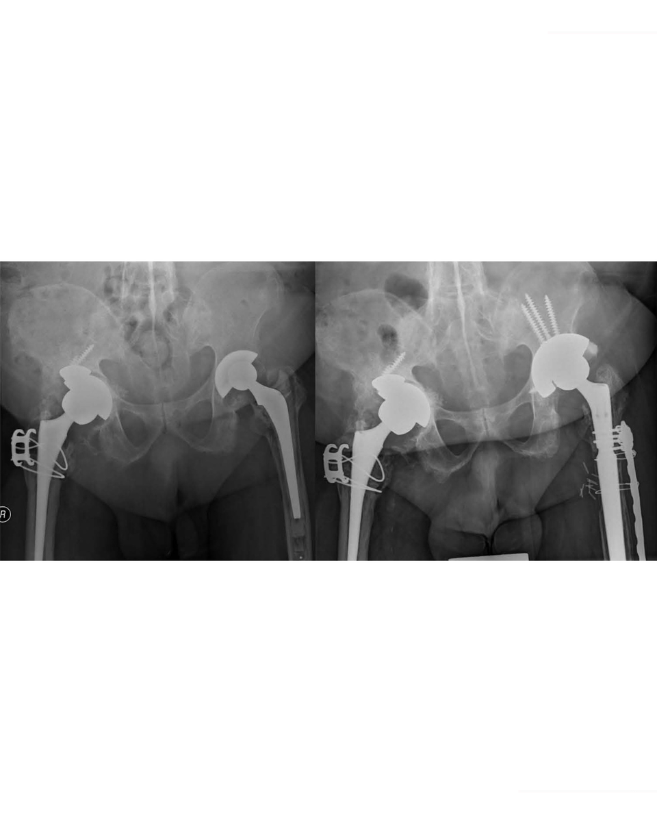 Bone & Joint Open (@bonejointopen) on Twitter photo This study provides evidence of excellent long-term survival of cementless components without screw holes. Immediate postoperative weightbearing did not lead to component migration in the long term.
#BJO #HipArthroplasty #Weightbearing #FOAMed <a href="/LCMLau/">Lawrence Lau</a>
ow.ly/RM1P50VMk7j This study provides evidence of excellent long-term survival of cementless components without screw holes. Immediate postoperative weightbearing did not lead to component migration in the long term.
#BJO #HipArthroplasty #Weightbearing #FOAMed <a href="/LCMLau/">Lawrence Lau</a>
ow.ly/RM1P50VMk7j