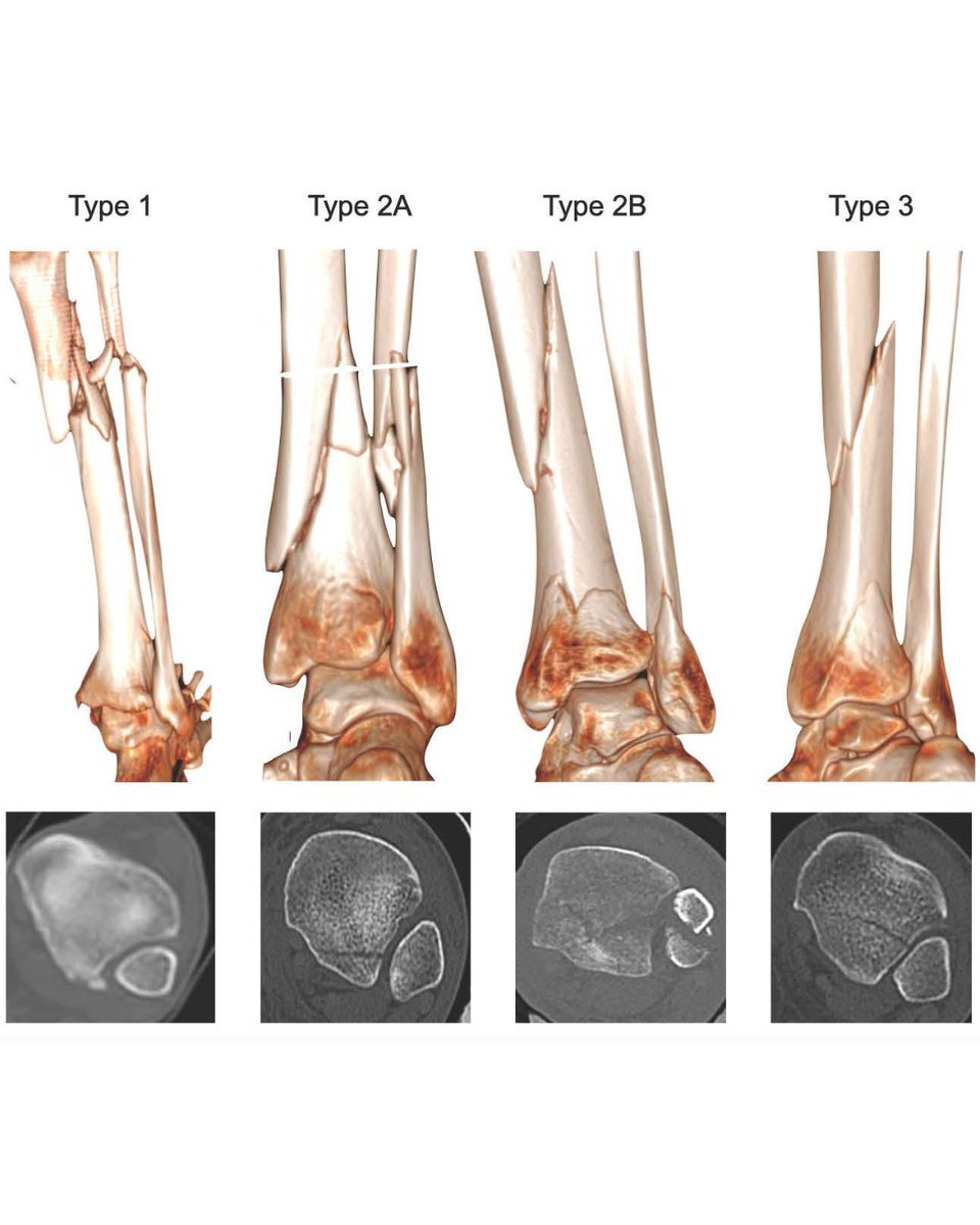 The most common posterior malleolar fracture (PMF) seen in this study was the minor rotational pilon (type 2A). The majority of PMFs were undisplaced pre-surgical intervention except the 2B subtype (major rotational pilon).

#BJO #Ortho #Ankle #Fracture

ow.ly/Qg1n50VJQu2