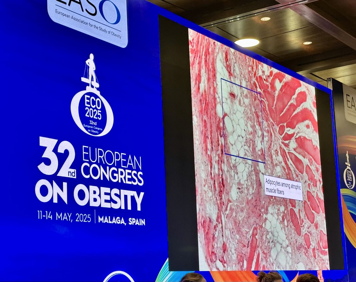 Juani Carretero Gomez (@carreterojuani) on Twitter photo Una imagen vale más que mil palabras
Infiltración grasa en músculo atrófico
La importancia del ejercicio físico sobre el músculo
En #ECO2025 <a href="/Diabetes_SEMI/">GT-SEMI Diabetes, Obesidad y Nutrición #17DM_SEMI</a> Una imagen vale más que mil palabras
Infiltración grasa en músculo atrófico
La importancia del ejercicio físico sobre el músculo
En #ECO2025 <a href="/Diabetes_SEMI/">GT-SEMI Diabetes, Obesidad y Nutrición #17DM_SEMI</a>