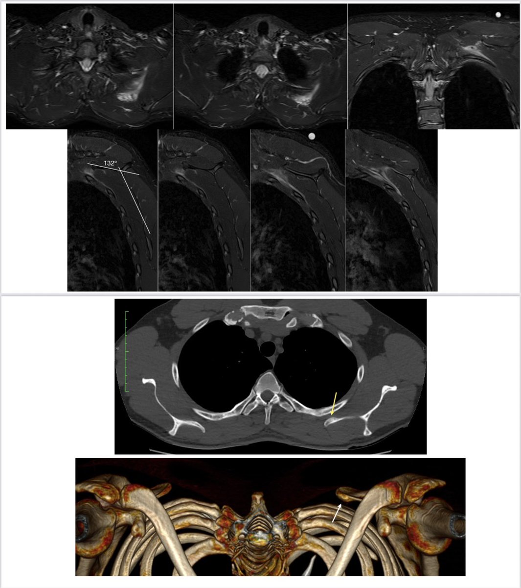 ARTRORM's tweet image. Adventitial scapulothoracic bursitis and bony prominence in supero medial scapular angle.
Scapular Dyskinesia