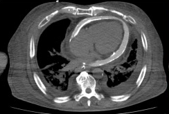 enlight524's tweet photo. “milk of calcium” pericardial effusion
https://t.co/u2c7CLNDR4
高濃度心嚢液貯留（130～150HU）と心外膜、心膜に沿った石灰化、心膜腔にはピンクの濁った高粘性の液体（衝撃的すぎるのでカットしました。linkからどうぞ）
培養でG群β溶血性連鎖球菌。
＃JRS84 ＃JRC2025 シンポジウム14 Ai https://t.co/aflPgivrYa
