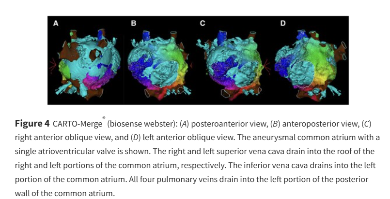 European Society of Cardiology Journals (@esc_journals) on Twitter photo Find out how catheter ablation of atrial flutter was performed in a univentricular heart, common atrium & single AV valve ow.ly/VvB950VOPeG
#EHJCaseReports <a href="/Phiso_de/">Philipp Sommer</a> <a href="/TJ_Yeo/">Tee Joo YEO</a> <a href="/aayshacader/">Aaysha Cader</a> <a href="/BoldiKovacsMD/">Boldizsar Kovacs</a> <a href="/KardiologieHH/">Erik Rafflenbeul</a> <a href="/ANazmiCalik/">A.Nazmi Calik</a> <a href="/O_Azizy_MD/">Obayda Azizy</a> <a href="/saramoscatelli7/">Sara Moscatelli</a> <a href="/EHJCREiC/">EHJCaseReports Editor-in-Chief</a> Find out how catheter ablation of atrial flutter was performed in a univentricular heart, common atrium & single AV valve ow.ly/VvB950VOPeG
#EHJCaseReports <a href="/Phiso_de/">Philipp Sommer</a> <a href="/TJ_Yeo/">Tee Joo YEO</a> <a href="/aayshacader/">Aaysha Cader</a> <a href="/BoldiKovacsMD/">Boldizsar Kovacs</a> <a href="/KardiologieHH/">Erik Rafflenbeul</a> <a href="/ANazmiCalik/">A.Nazmi Calik</a> <a href="/O_Azizy_MD/">Obayda Azizy</a> <a href="/saramoscatelli7/">Sara Moscatelli</a> <a href="/EHJCREiC/">EHJCaseReports Editor-in-Chief</a>