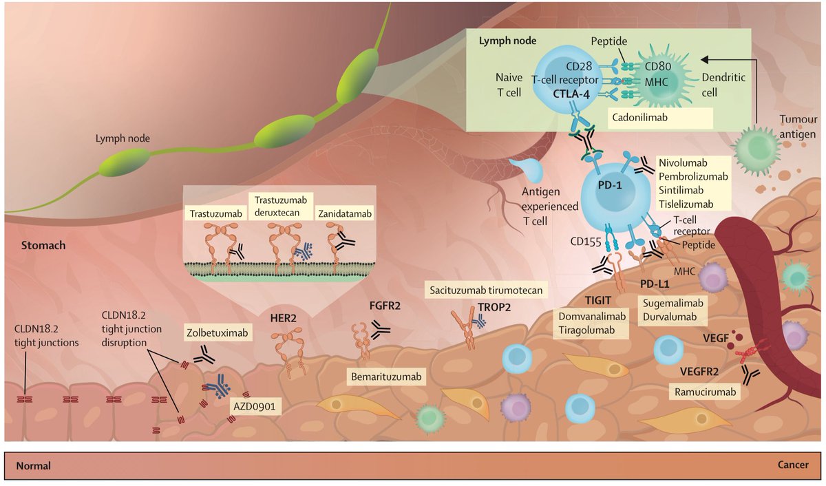 Sociedad Española de Patología Digestiva (SEPD) (@sepdigestiva) on Twitter photo Cáncer gástrico: lectura recomendada vía <a href="/TheLancet/">The Lancet</a> ‼️🆕
1️⃣ Incidencia y mortalidad global
2️⃣ Manejo quirúrgico
3️⃣ Tratamiento para la enfermedad avanzada
4️⃣ Tratamientos actuales y futuros
📸: thelancet.com/journals/lance… Cáncer gástrico: lectura recomendada vía <a href="/TheLancet/">The Lancet</a> ‼️🆕
1️⃣ Incidencia y mortalidad global
2️⃣ Manejo quirúrgico
3️⃣ Tratamiento para la enfermedad avanzada
4️⃣ Tratamientos actuales y futuros
📸: thelancet.com/journals/lance…