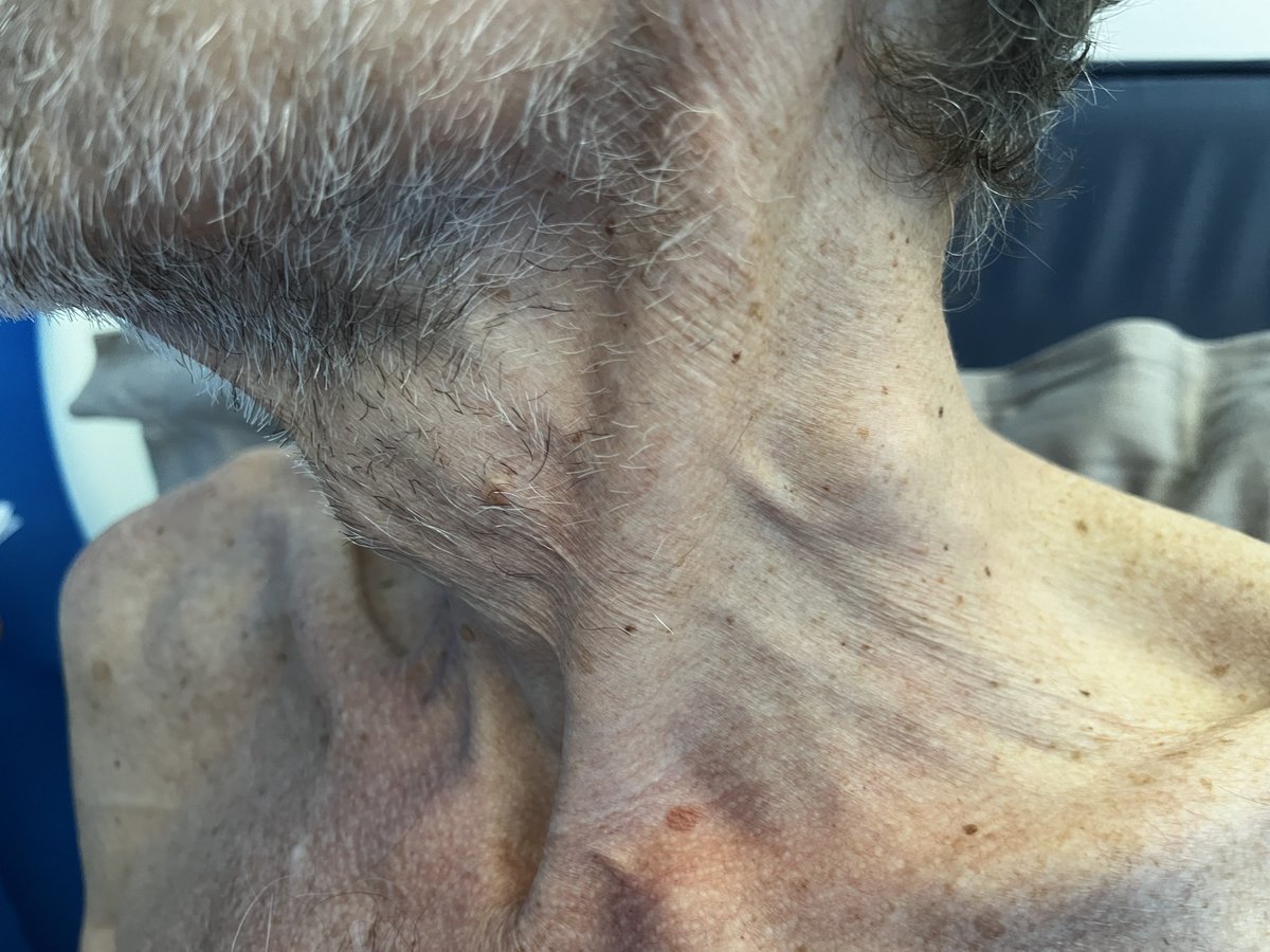 Who says clinical examination is lost? This patient presented with heartburn and weight loss. What’s the diagnosis? #WithConsent