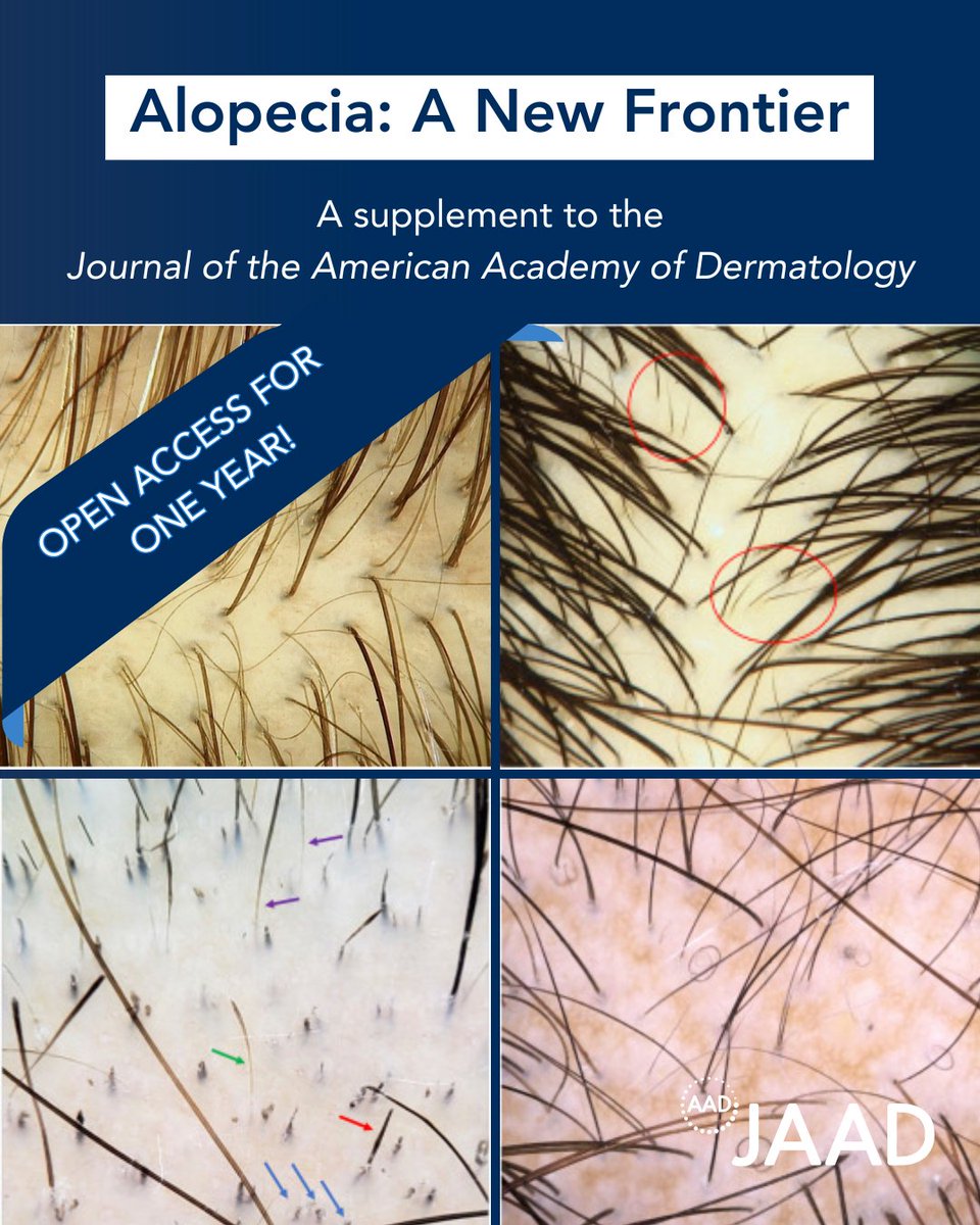 Big news! The AAD CME Supplement on Alopecia is now open access for another year. This supplement encompasses patient evaluation, treatment, and drug information surrounding alopecia. bit.ly/3KJIeOA