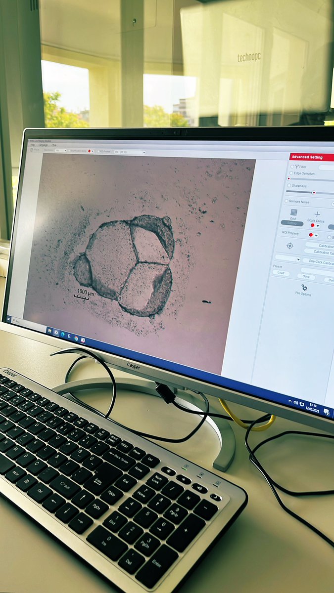SevdeAltuntas's tweet image. Hasta kökenli pankreas kanseri tümoroidleri bugün yaklaşık 1 cm.  Türkiye’de hasta tümörlerinden ilaç tarayabilecek birkaç ekipten biriyiz, pankreas kanseri için belki ilkiyiz. Klinik çalışmalarımıza yakında yeni hastalar alacağız. #AltuntasLab #devam 🇹🇷🇹🇷🇹🇷 @sbuedutr @SBUDETUAM