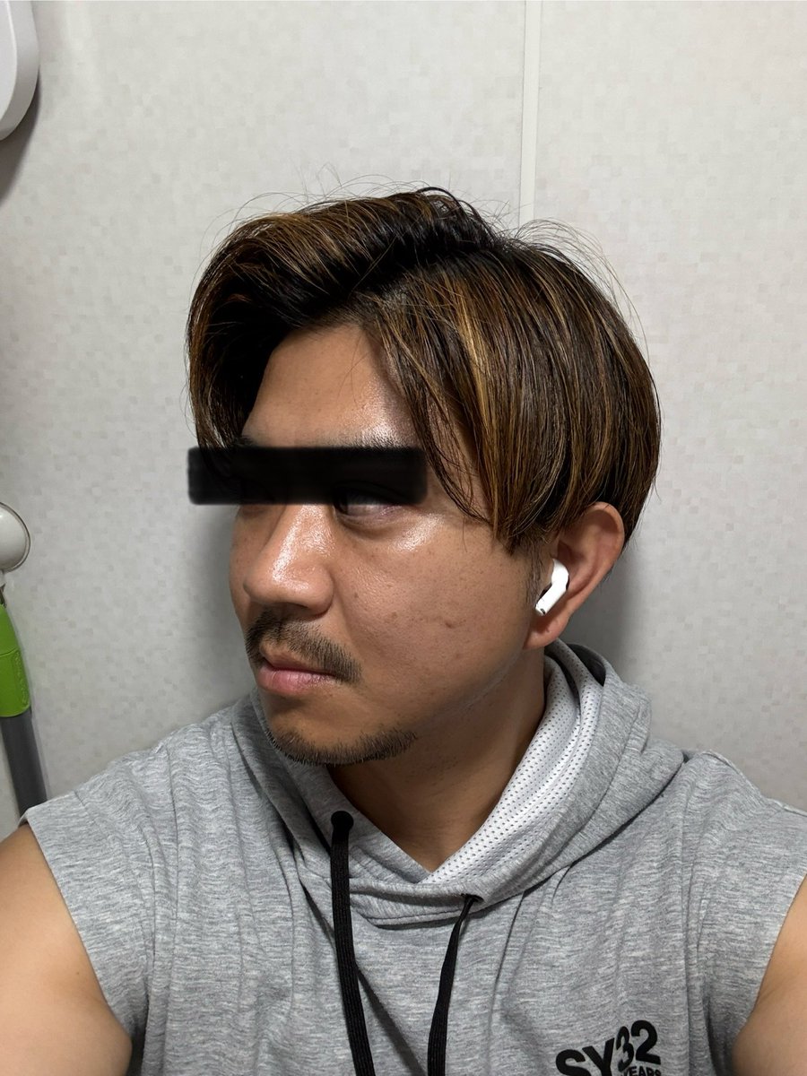 実は韓国のST美容整形外科で、クマ取り&amp;脂肪注入して来ました。
1.ゴルゴライン
2.目のギョロッ
3.目尻の脂肪
クマと言うよりは、目の下を綺麗にしてアンチエイジングしたいのと、知り合いがやって良くなっていたので挑戦しました。
続く
↓やる前
＃くまとり 
＃ST美容整形外科 
＃江南 
＃整形