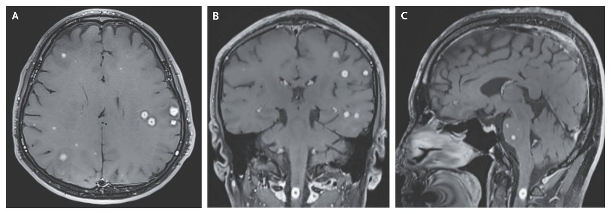 Images in Clinical Medicine: Central Nervous System Tuberculomas nej.md/4k2iWKZ 

#Neurology