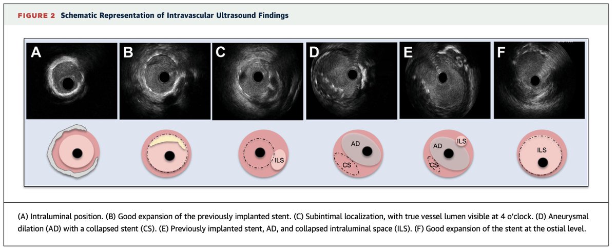 We present an #unusual case of angiographically severe #ISR with aneurysmal vessel remodeling of the #RCA 5 years after #PCI due to #CTO. #IVUS provided crucial insights (#videos available)

authors.elsevier.com/a/1l3Ih6uPJvyJ…