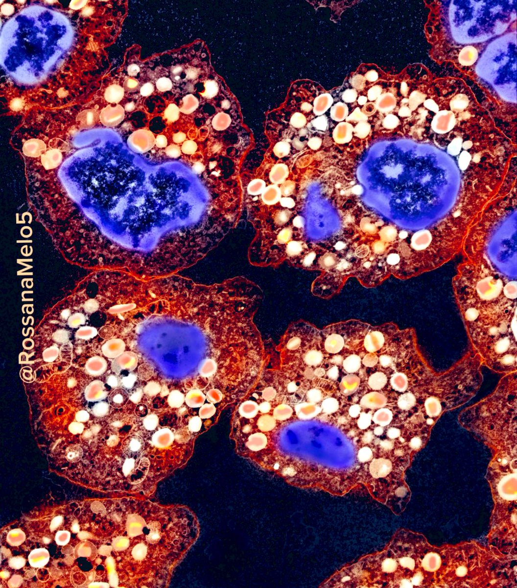 A silent surge in the bloodstream: Hypereosinophilia! #eosinophils
#MicroscopyMonday #sciart #electronmicroscopy