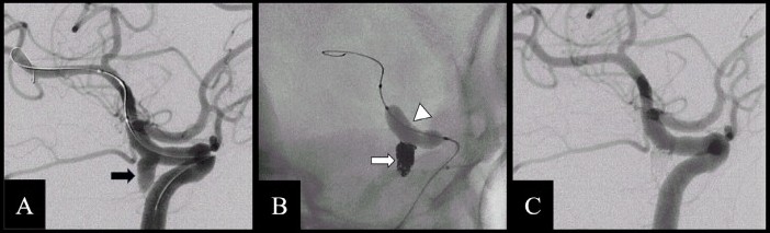 Journal of Neuroimaging (@jneuroimaging) on Twitter photo Safety/Efficacy of a Pusher, Thermal Detachment Coil for Ruptured Intracranial Aneurysms: A Multicenter Real‐World Study
onlinelibrary.wiley.com/doi/10.1111/jo…
#neuroimaging #neurology #neurotwitter #neuroscience #neurorad #radres <a href="/WileyNeuro/">Wiley Neuro</a> <a href="/asneuroimaging/">American Society of Neuroimaging</a> #aneurysm #coil
Free read Safety/Efficacy of a Pusher, Thermal Detachment Coil for Ruptured Intracranial Aneurysms: A Multicenter Real‐World Study
onlinelibrary.wiley.com/doi/10.1111/jo…
#neuroimaging #neurology #neurotwitter #neuroscience #neurorad #radres <a href="/WileyNeuro/">Wiley Neuro</a> <a href="/asneuroimaging/">American Society of Neuroimaging</a> #aneurysm #coil
Free read