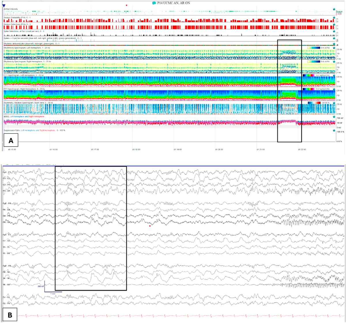Annals of the Child Neurology Society (@annalscns) on Twitter photo Intrathecal dexamethasone may be a promising intervention in FIRES. Read more in the new #OpenAccess article by Carol Park & colleagues: onlinelibrary.wiley.com/doi/10.1002/cn…
@wileyneuro <a href="/Thindmints/">Sonam Thind</a> <a href="/TareqKass/">Tareq Kass-Hout</a> <a href="/hanin_aurelie/">Hanin Aurélie</a> <a href="/drhibahaider/">Hiba A. Haider MD</a> <a href="/Douglas_Nordli/">Douglas R. Nordli III MD</a> #epilepsy Intrathecal dexamethasone may be a promising intervention in FIRES. Read more in the new #OpenAccess article by Carol Park & colleagues: onlinelibrary.wiley.com/doi/10.1002/cn…
@wileyneuro <a href="/Thindmints/">Sonam Thind</a> <a href="/TareqKass/">Tareq Kass-Hout</a> <a href="/hanin_aurelie/">Hanin Aurélie</a> <a href="/drhibahaider/">Hiba A. Haider MD</a> <a href="/Douglas_Nordli/">Douglas R. Nordli III MD</a> #epilepsy
