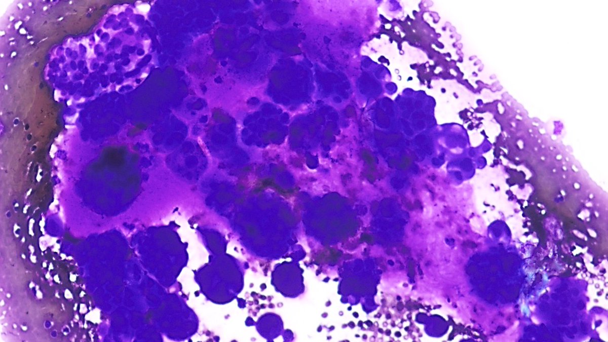 Pepe Jiménez Heffernan (@pepeheffernan) on Twitter photo Part 2. If you like to fly low⬇️. It does not show the cells either, but we can see some of the scarce material they produce. Nice but unusual image. Here's a hint: We see it very infrequently in effusions (endogenous production) but more and more in FNA <a href="/DrBMcGinn/">Barry McGinn</a> <a href="/kriyer68/">Kalyani Bambal</a> Part 2. If you like to fly low⬇️. It does not show the cells either, but we can see some of the scarce material they produce. Nice but unusual image. Here's a hint: We see it very infrequently in effusions (endogenous production) but more and more in FNA <a href="/DrBMcGinn/">Barry McGinn</a> <a href="/kriyer68/">Kalyani Bambal</a>