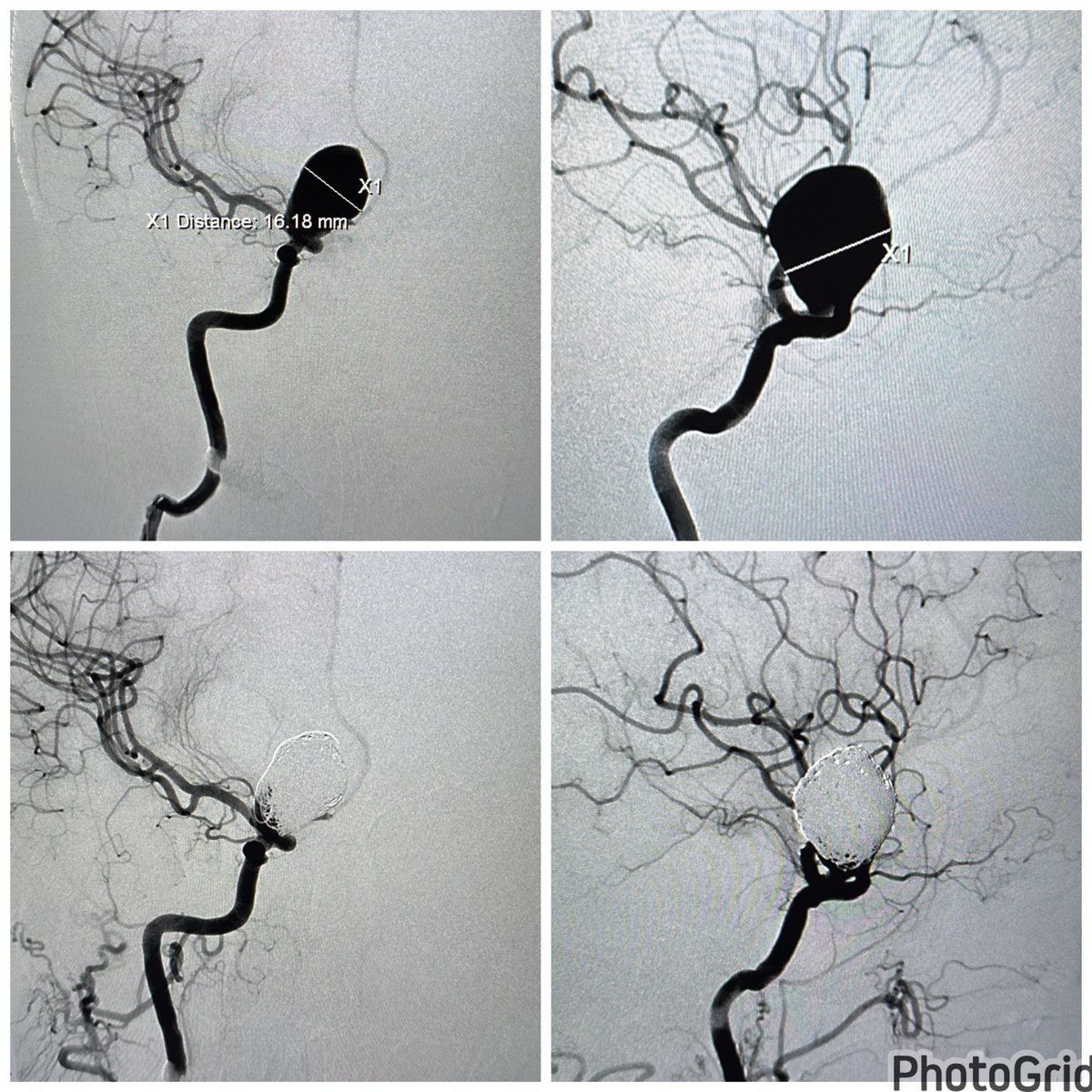 Vladimir Kalousek (@vladimirkzagreb) on Twitter photo Ruptured large ICA aneurysm streamed live for <a href="/esmintsociety/">ESMINT Society</a> <a href="/EYMINT_ESMINT/">EYMINT</a> e fellows via <a href="/TegusMedical/">Tegus Medical GmbH</a> system. Coiling done in first stage, if patients recovers 2nd stage will be some more coils and fd. <a href="/Fie0815/">Jens Fiehler</a> <a href="/PascalJabbourMD/">Pascal Jabbour MD, FAANS, FACS, FAHA</a> <a href="/italolinfante/">IL</a> <a href="/MDoctoronboard/">Matthias Bechstein</a> <a href="/neuroangio1/">Neuroangio</a> Ruptured large ICA aneurysm streamed live for <a href="/esmintsociety/">ESMINT Society</a> <a href="/EYMINT_ESMINT/">EYMINT</a> e fellows via <a href="/TegusMedical/">Tegus Medical GmbH</a> system. Coiling done in first stage, if patients recovers 2nd stage will be some more coils and fd. <a href="/Fie0815/">Jens Fiehler</a> <a href="/PascalJabbourMD/">Pascal Jabbour MD, FAANS, FACS, FAHA</a> <a href="/italolinfante/">IL</a> <a href="/MDoctoronboard/">Matthias Bechstein</a> <a href="/neuroangio1/">Neuroangio</a>