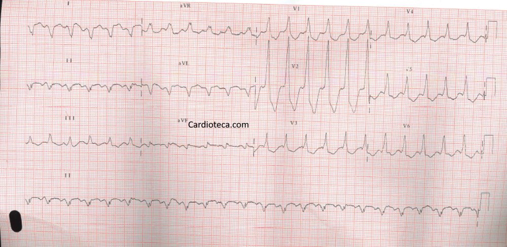 CardioTeca (@cardioteca) on Twitter photo 🆕❤️ #ECGCardioTeca 630 - 70 años que hace 8 años tuvo un infarto en la cara inferior del corazón. Ahora tiene este ECG. ¿Cuál es el diagnóstico más probable?
👉 cardioteca.com/cardioteca-red…
#cardiologia #cardiotwitter <a href="/HiguerasJavier/">javier higueras</a> #ecg 🆕❤️ #ECGCardioTeca 630 - 70 años que hace 8 años tuvo un infarto en la cara inferior del corazón. Ahora tiene este ECG. ¿Cuál es el diagnóstico más probable?
👉 cardioteca.com/cardioteca-red…
#cardiologia #cardiotwitter <a href="/HiguerasJavier/">javier higueras</a> #ecg