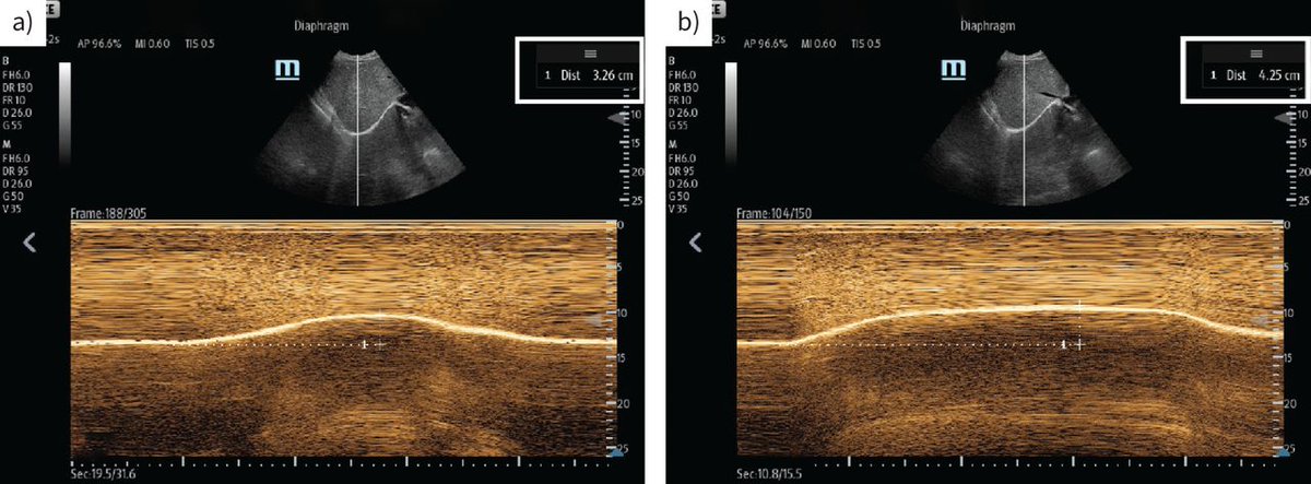 Endobronchial valve treatment improves diaphragm function in severe emphysema patients. This emphasises the interaction between hyperinflation and diaphragm function, suggesting that reducing hyperinflation can partially reverse diaphragm dysfunction. bit.ly/4ft2QYj