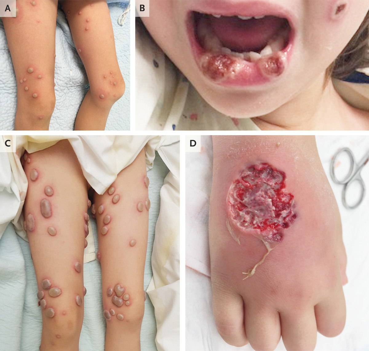 Fever and high leukocytosis.
What is the description or diagnosis?