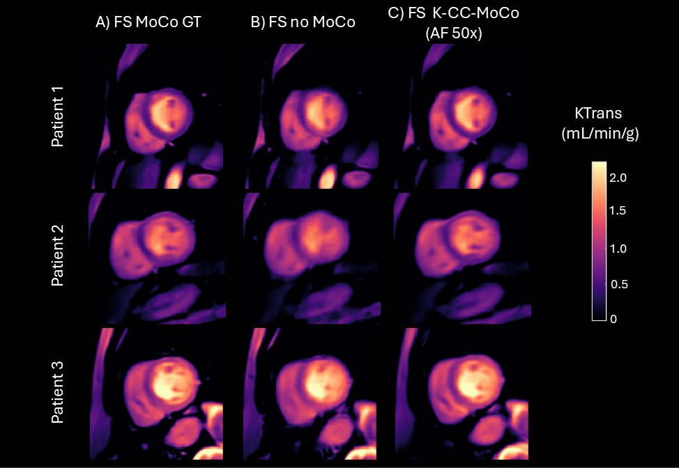 ISMRM Iberian Chapter (@ismrmiberian) on Twitter photo Do you need to apply motion corrections? <a href="/emoysae/">Elisa Moya Sáez</a> <a href="/LPI_Lab/">Image Processing Lab (LPI) - Valladolid</a> presents "K-CC-MoCo: A fast respiratory motion correction in coil-compressed K-space for highly accelerated first-pass perfusion cardiac MRI", 08:15am, Room 312. Do you need to apply motion corrections? <a href="/emoysae/">Elisa Moya Sáez</a> <a href="/LPI_Lab/">Image Processing Lab (LPI) - Valladolid</a> presents "K-CC-MoCo: A fast respiratory motion correction in coil-compressed K-space for highly accelerated first-pass perfusion cardiac MRI", 08:15am, Room 312.